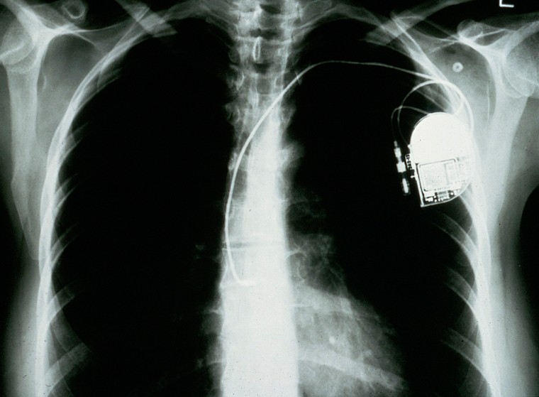 An X-ray image of a human chest with a pacemaker in situ, with a wire leading to the heart.