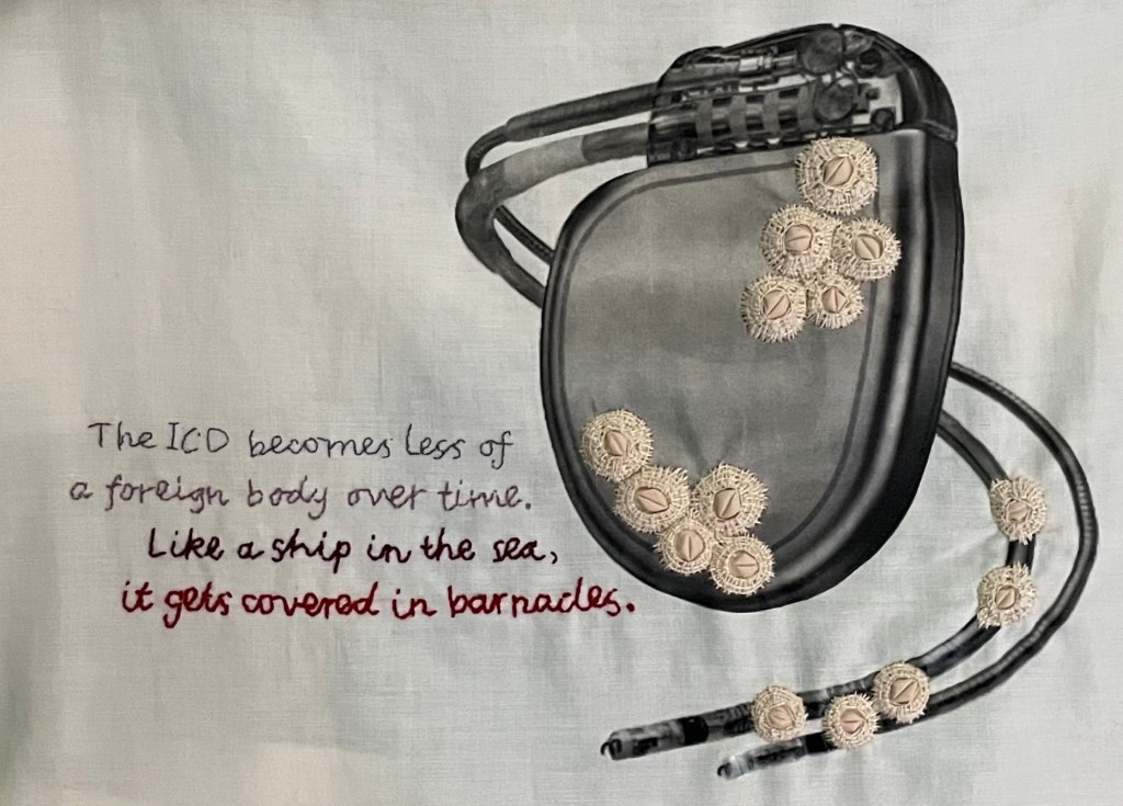 Off-white fabric with a photograph of a two-leaded cardiac device transferred onto its surface. Embroidered across the device generator and leads are a number of cream objects reminiscent of barnacles. To the left of this image are four lines of embroidered text, changing in colour from silver/grey to red and becoming thicker on each line. The text reads: "The ICD becomes less of a foreign body over time. Like a ship in the sea, it gets covered in barnacles."